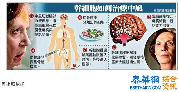 干细胞疗法 中风病人恢复行动