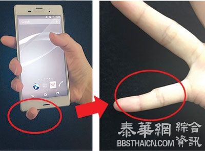 长期玩智能手机　弄至尾指变形