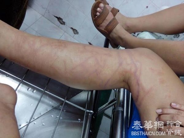 2老外甲米府遇毒水母 所幸及时送到医院抢救注射血清