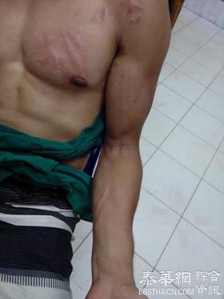 2老外甲米府遇毒水母 所幸及时送到医院抢救注射血清