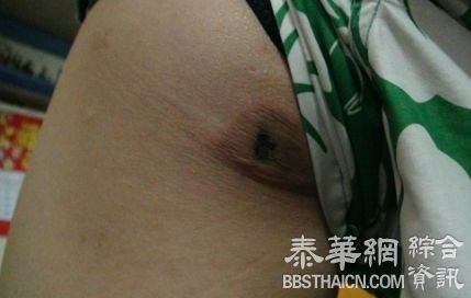 三星A9手机无故自焚 烧黑港男屁股