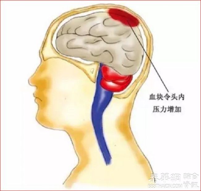 脑血管崩溃前有10个信号+5个预防