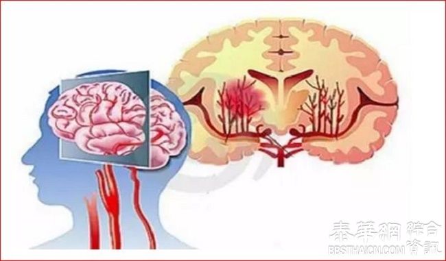 脑血管崩溃前有10个信号+5个预防