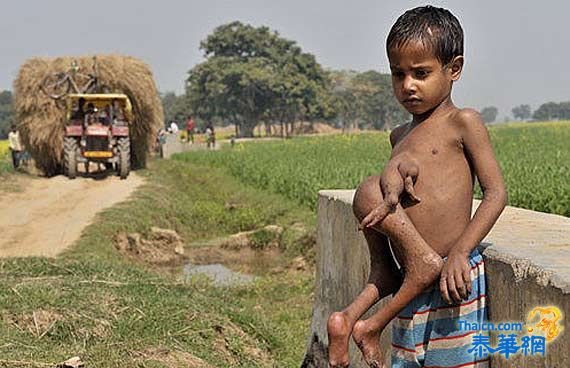 胸前长着双脚 印度7岁男孩饱受寄生胎之苦
