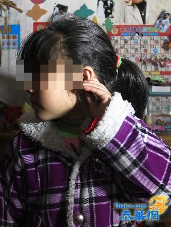 上海松江一年级女生调皮 被老师揪耳朵伤口缝5针