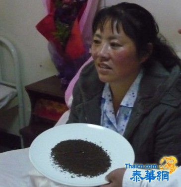 昆明罗女士“保胆取石”上万颗，欲申请吉尼斯世界纪录