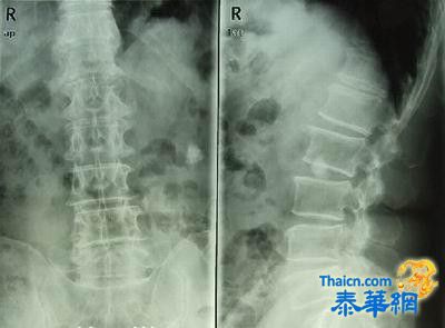 一个治疗腰椎间盘突出症的秘方